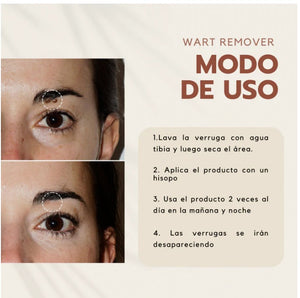 Wart Remover - Removedor de Verrugas y Lunares